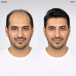 Men's Hair System – before and after, front view, shade M1A, 8*10 انش